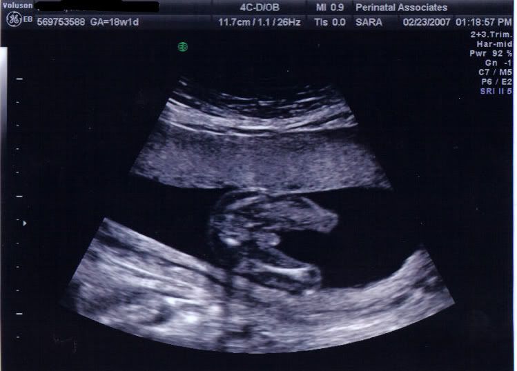 新品稀少/LP/LAST CHILD/PRIVATE SCAN'DAL Case # 19: 32 Weeks 3 Days Pregnancy Scan | Posterior
